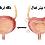 راه‌های سریع برای مقابله با فعالیت زیاد مثانه