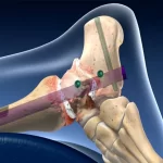 راهنمای کامل انجام جراحی فیوژن مچ پا برای درمان آرترودز: عوارض و مراحل اجرایی
