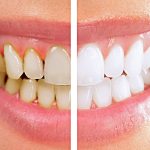 ۱۰ روش جادویی برای داشتن لبخندی براق و دندان های سفید نیک