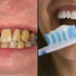 چگونه می‌توانیم پیشگیری از زرد شدن دندان‌ها کنیم؟