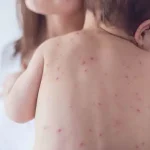 تعبیر خواب آبله مرغان در بدن برای زن متاهل و باردار و دختر مجرد از روانشناسی