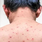 تعبیر خواب آبله مرغان گرفتن برای زن متاهل و باردار و دختر مجرد از روانشناسی