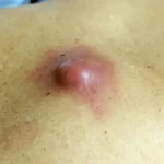 تعبیر خواب دمل از نظر امام صادق برای زن متاهل و باردار و دختر مجرد از روانشناسی