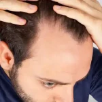 تعبیر خواب کم مویی برای زن متاهل و باردار و دختر مجرد از روانشناسی