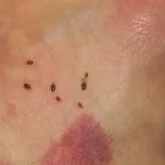 تعبیر خواب نیش زدن ساس برای زن متاهل و باردار و دختر مجرد از روانشناسی