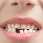 تعبیر خواب افتادن دندان در اسلام امام صادق برای زن متاهل و باردار و دختر مجرد