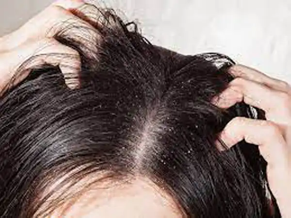 تعبیر خواب ساس در موی سر برای زن متاهل و باردار و دختر مجرد از روانشناسی
