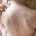 تعبیر خواب تاول زدن بدن بچه برای زن متاهل و باردار و دختر مجرد از روانشناسی
