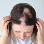 تعبیر خواب طاس شدن زن برای زن متاهل و باردار و دختر مجرد از روانشناسی