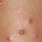 تعبیر خواب تاول چرکی برای زن متاهل و باردار و دختر مجرد از روانشناسی