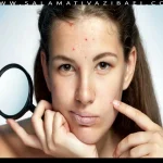 رابطه سطوح استروژن و آکنه