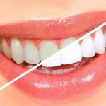به گفته دندانپزشکان چگونه دندان های زرد را به طور طبیعی سفید کنیم؟