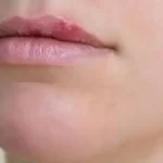 تعبیر خواب تبخال روی لب چیست برای زن متاهل و باردار و دختر مجرد از روانشناسی