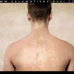 علت ایجاد لکه های سفید پوستی