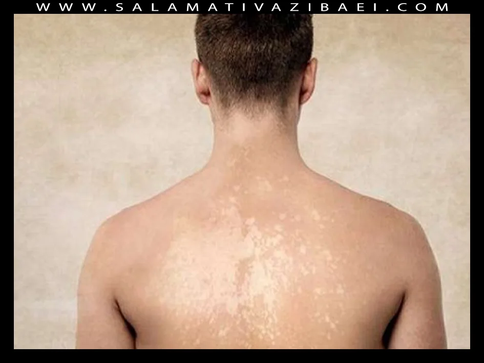 علت ایجاد لکه های سفید پوستی