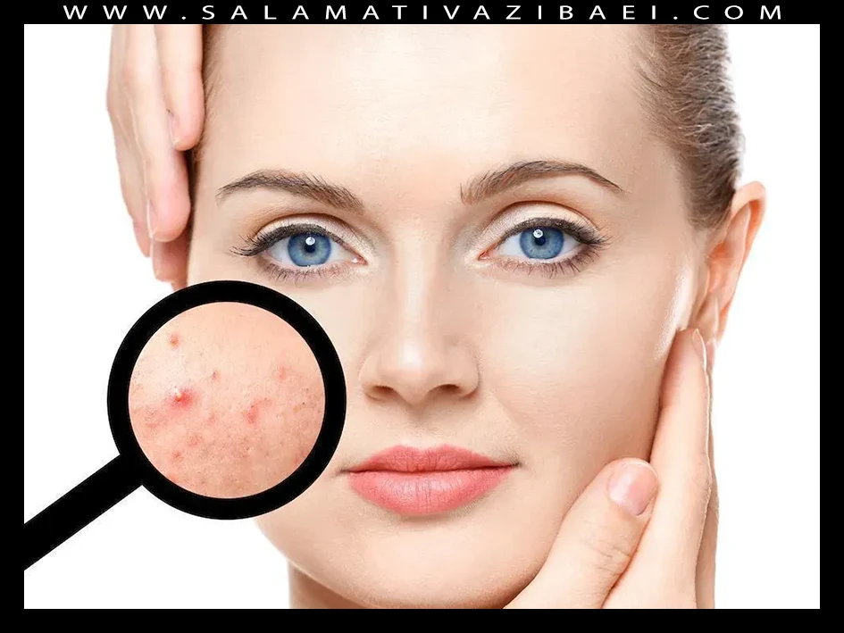 ۱۰ ماده ای که اگر آکنه دارید باید از آن اجتناب کنید و برای درمان آکنه نامناسب هستند