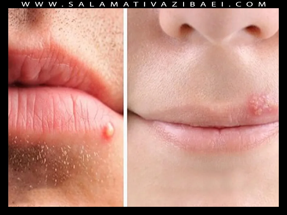 دلیل ایجاد جوش روی لب