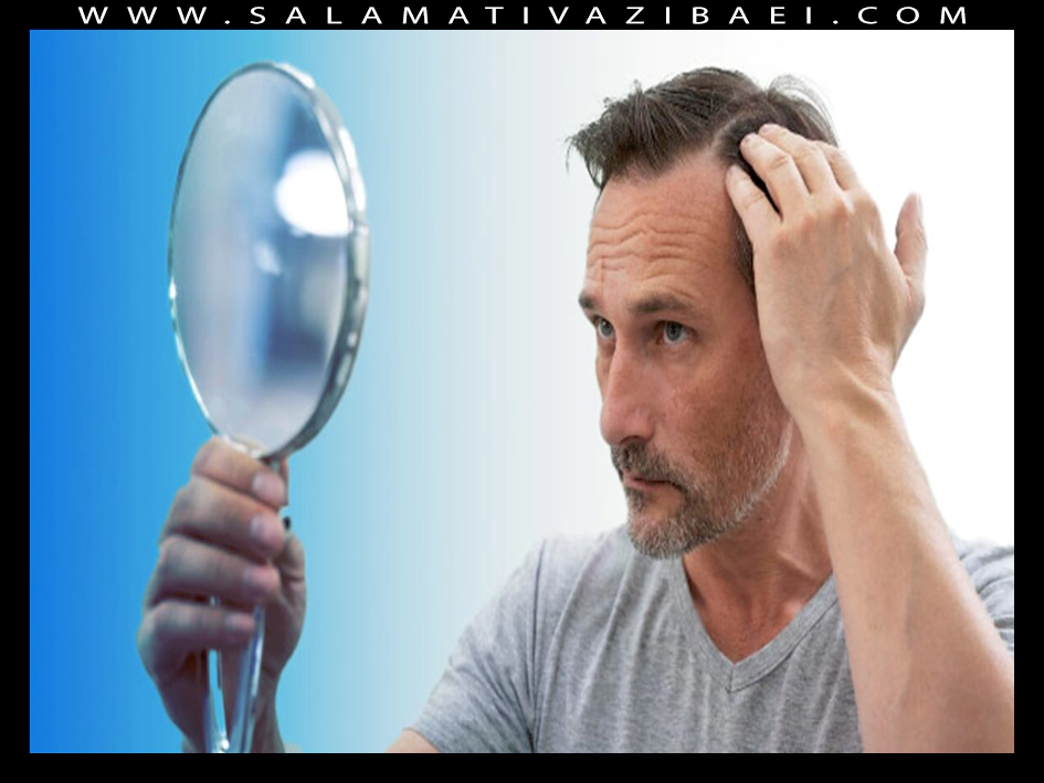 علل ریزش مو در شقیقه ها