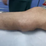تعبیر خواب غده در پا برای زن متاهل و باردار و دختر مجرد از روانشناسی