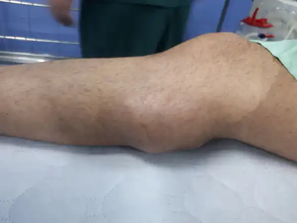 تعبیر خواب غده در پا برای زن متاهل و باردار و دختر مجرد از روانشناسی