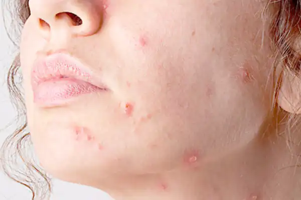 تعبیر خواب بیماری سرطان پوست برای زن متاهل و باردار و دختر مجرد از روانشناسی