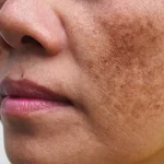تعبیر خواب سیاه شدن پوست بدن برای زن متاهل و باردار و دختر مجرد از روانشناسی
