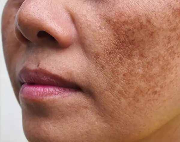 تعبیر خواب سیاه شدن پوست بدن برای زن متاهل و باردار و دختر مجرد از روانشناسی