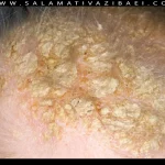 علل درماتیت سبورئیک