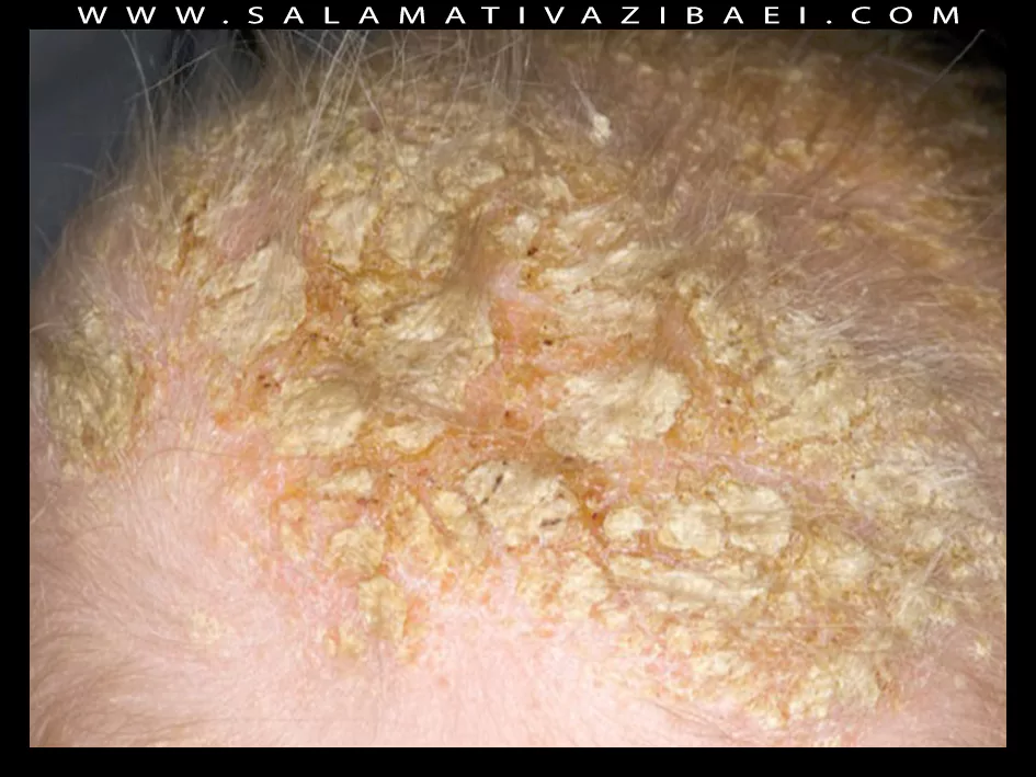 علل درماتیت سبورئیک