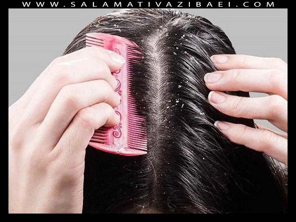 درمان های خانگی شوره سر
