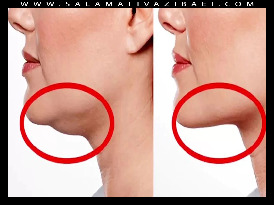 نحوه رفع غبغب