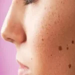 تعبیر خواب خال قهوه ای در صورت برای زن متاهل و باردار و دختر مجرد از روانشناسی