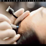 میکروبلیدینگ خط رویش مو چیست؟