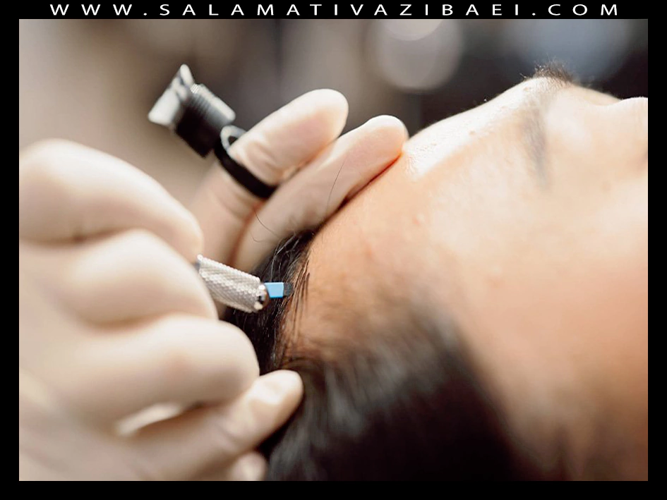 میکروبلیدینگ خط رویش مو چیست؟