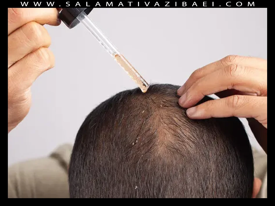 مضرات استفاده از ماینوکسیدیل – salamativazibaei