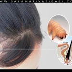 تأثیر انگل دمودکس بر فولیکول مو