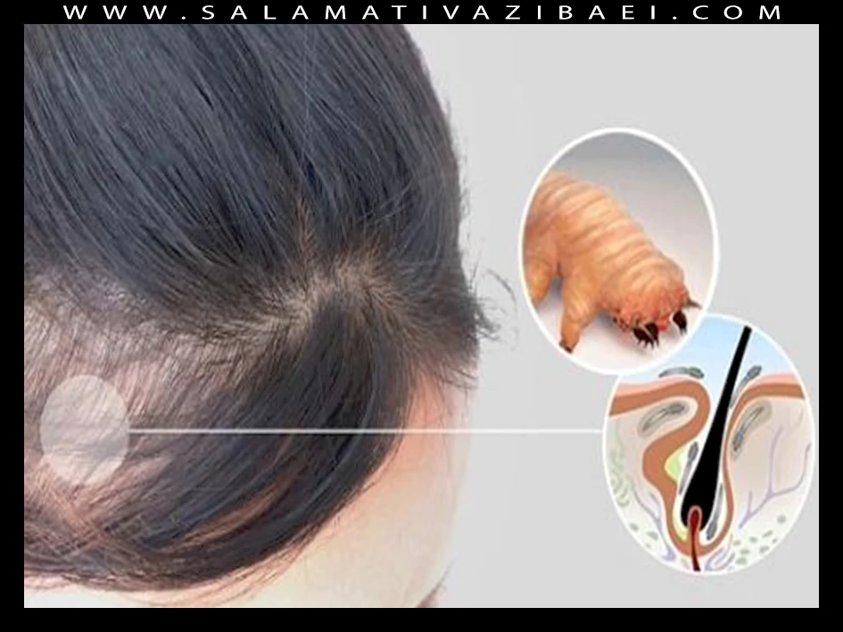 تأثیر انگل دمودکس بر فولیکول مو