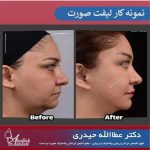 راه های تضمینی برای افزایش ماندگاری لیفت صورت