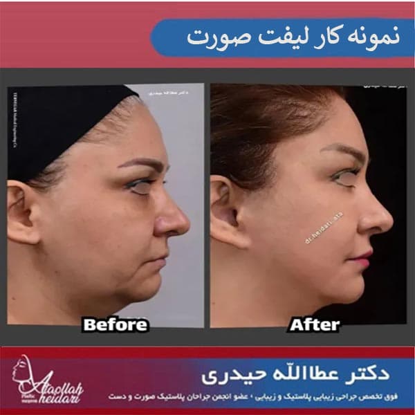 راه های تضمینی برای افزایش ماندگاری لیفت صورت
