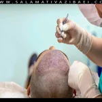 سرعت رشد مو بعد از کاشت مو