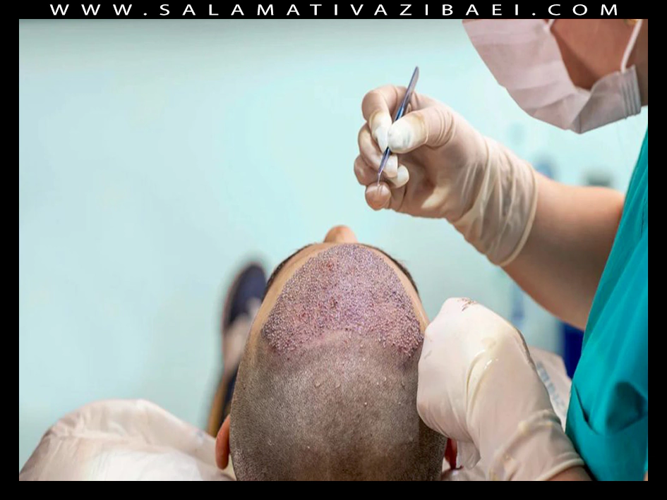 سرعت رشد مو بعد از کاشت مو