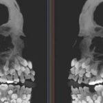 کشف نادر پزشکی در برزیل: دختری ۱۱ ساله که ۸۱ دندان دارد