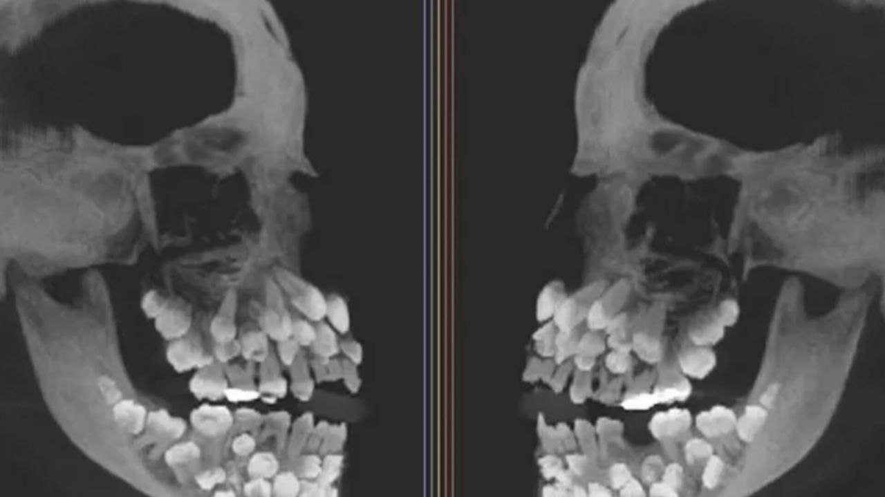 کشف نادر پزشکی در برزیل: دختری ۱۱ ساله که ۸۱ دندان دارد