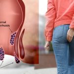 درمان قطعی بواسیر با لیزر؛  پایان دردهای همیشگی در بیماری های نشیمنگاهی