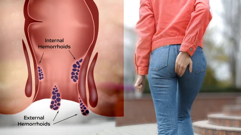 درمان قطعی بواسیر با لیزر؛  پایان دردهای همیشگی در بیماری های نشیمنگاهی