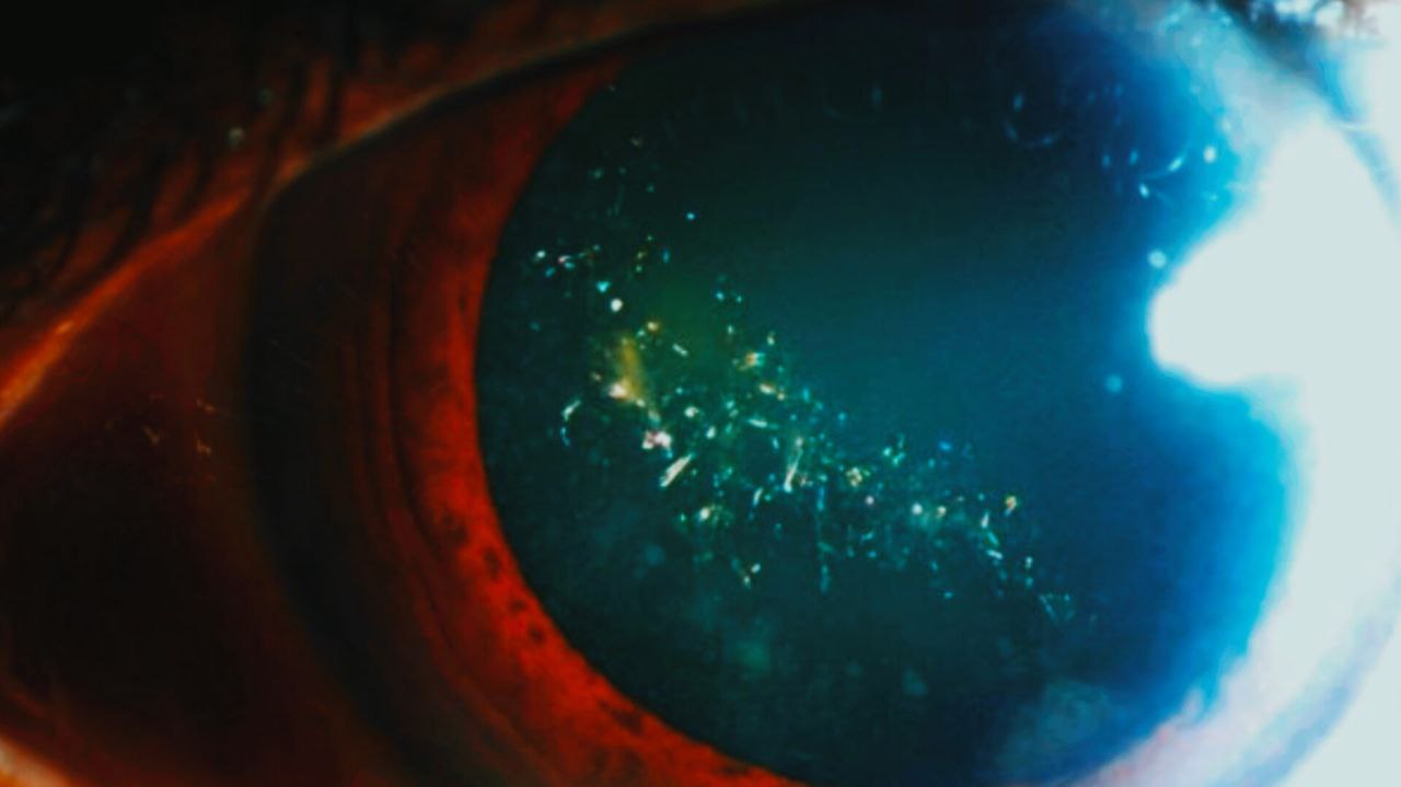 بیماری نادری که چشم‌ها را مانند درخت کریسمس درخشان می‌کند